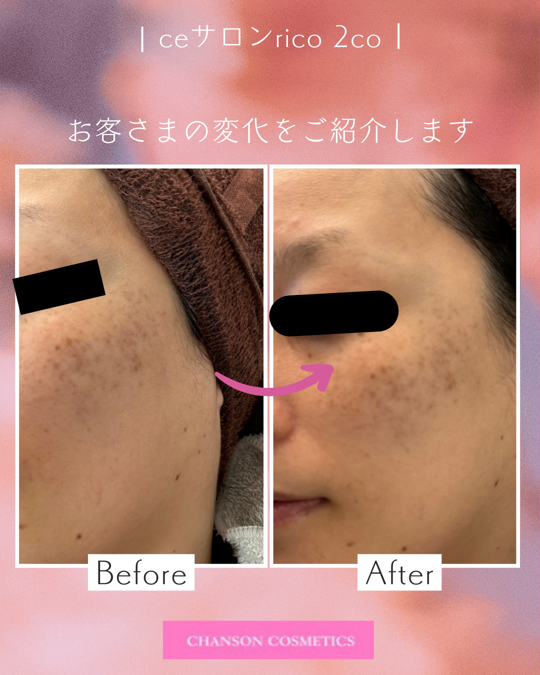 シミ肌をエステで改善