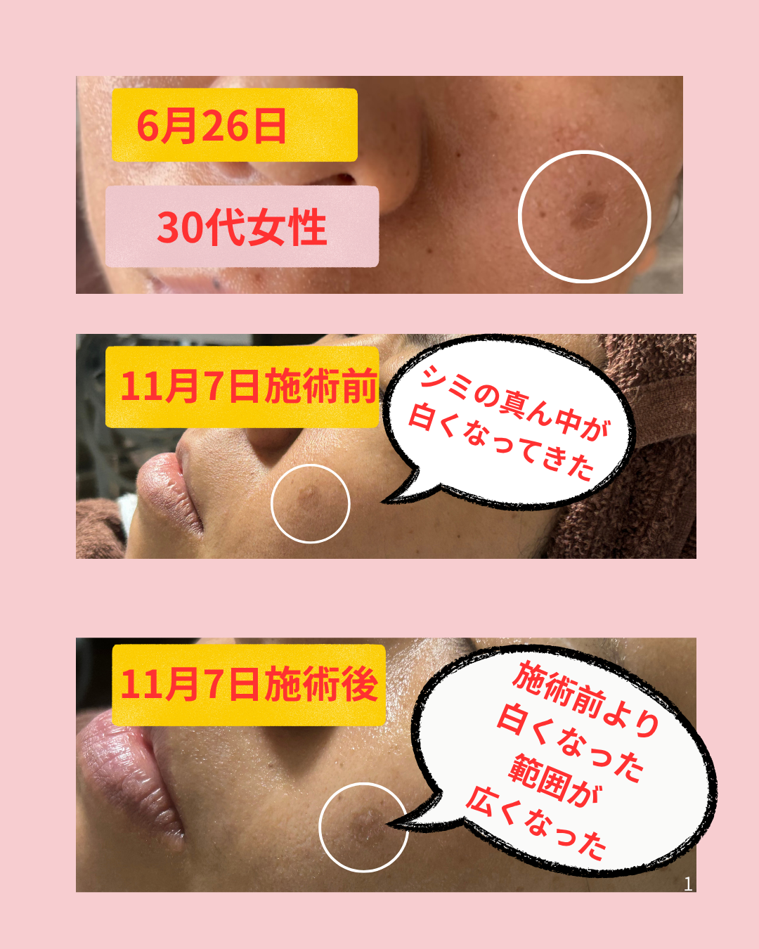 シミお悩み　３０代女性