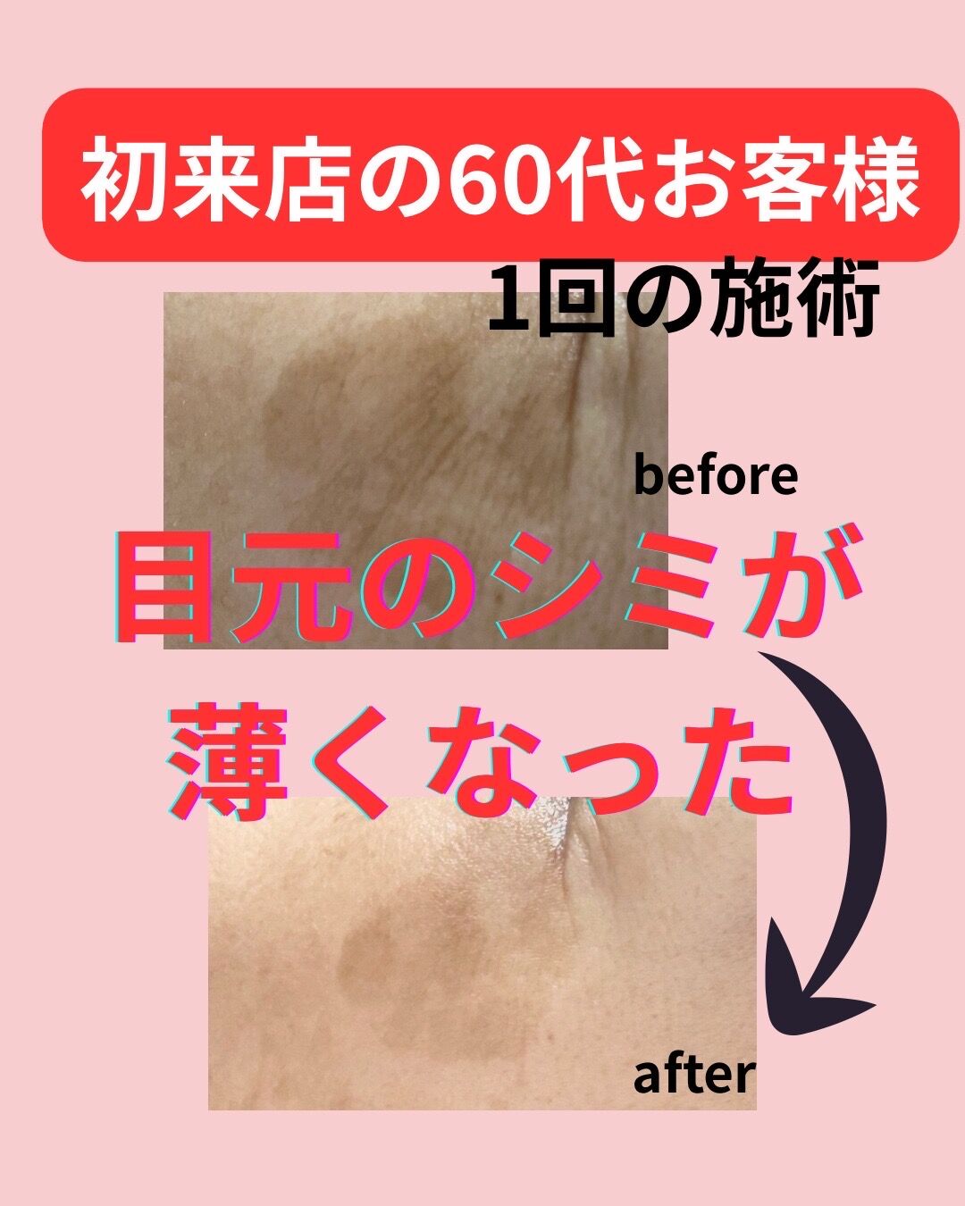 1回の施術効果はすごい
