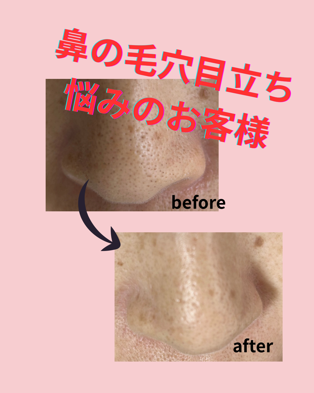 お鼻の毛穴スッキリ