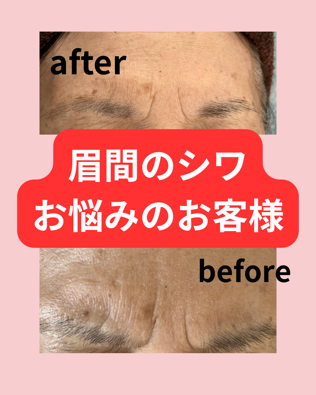 眉間のシワ
