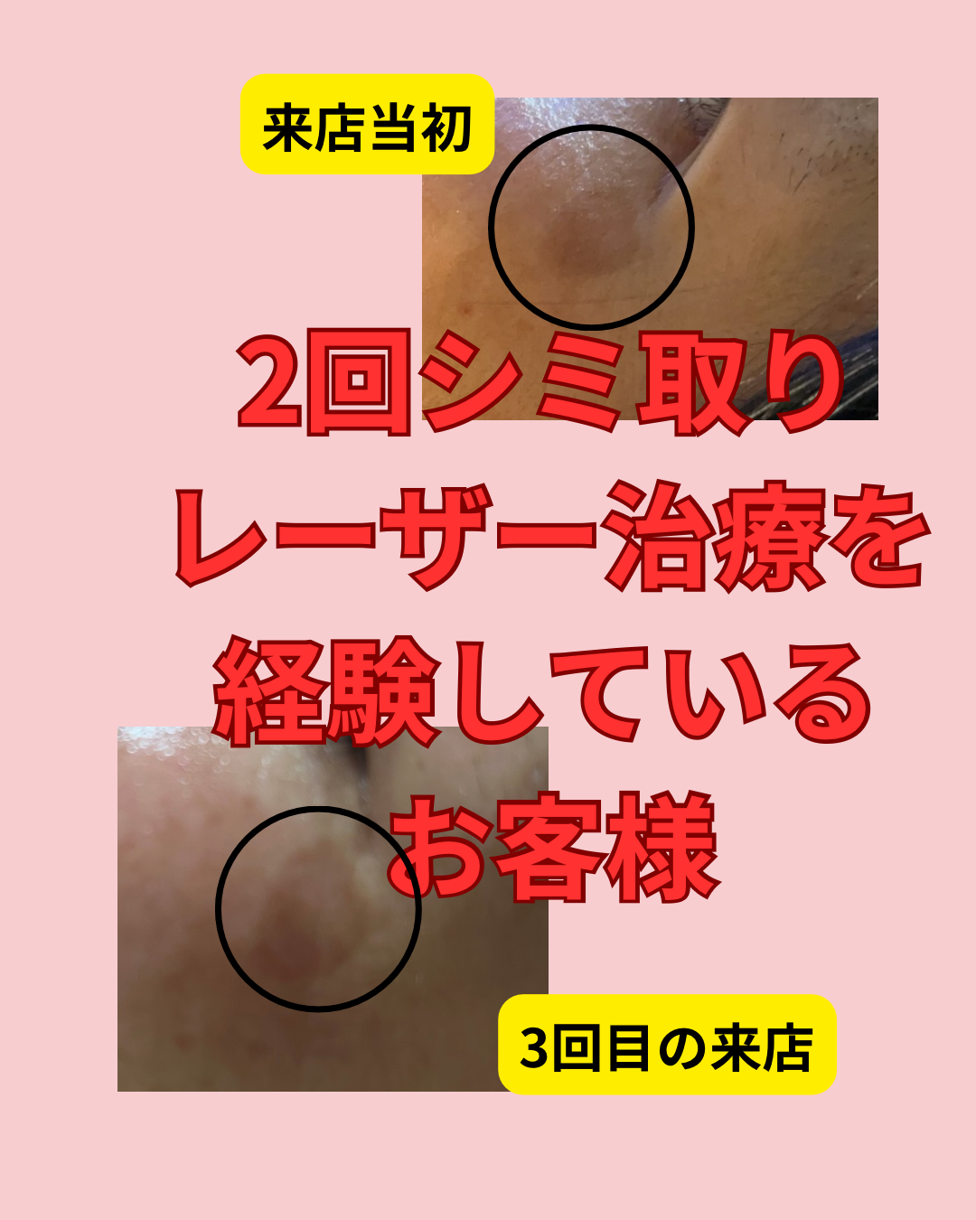 もう無理かな？シミ。エステで希望が戻った